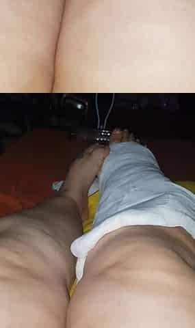 Wiggling My Toes in Cast