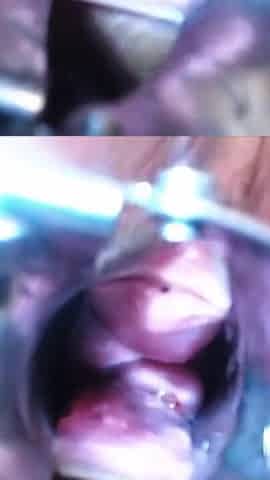 Speculum Cervix & Anal Exam Great View Inside