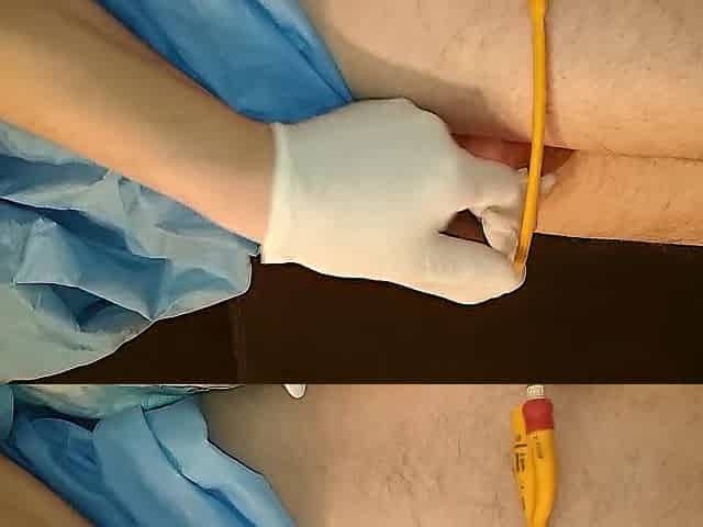put in 18FR catheter and tiny sounding play