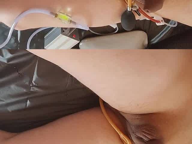 Massive stomach inflation using my enema machine and inflatable bardex nozzle
