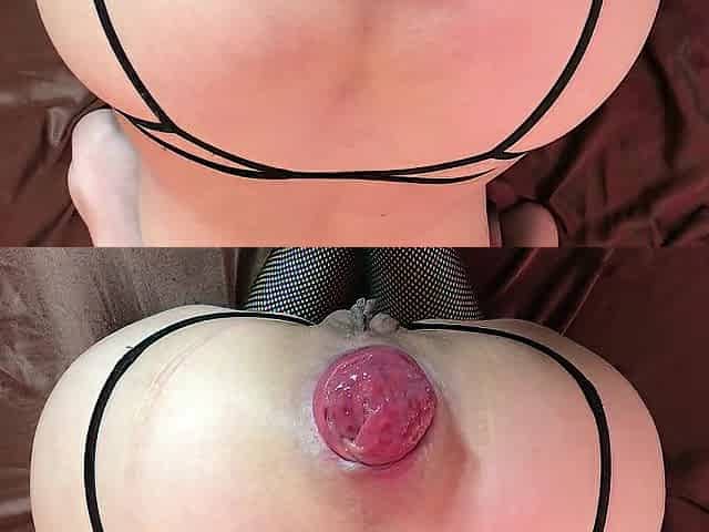 wifes and and husbands anal prolaps