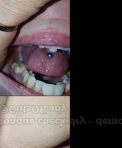 Throat and tongue check dry - demo