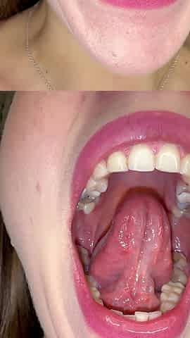 Mouth Secrets: Thick White Coating on My Tongue