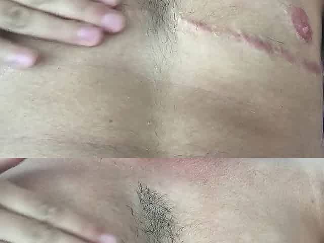 FtM Chest Scar Massage
