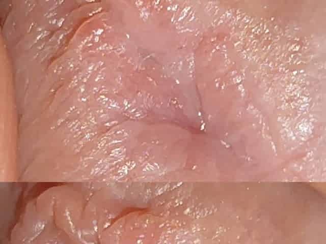Enlargement of the Deep Urethral Hole!!