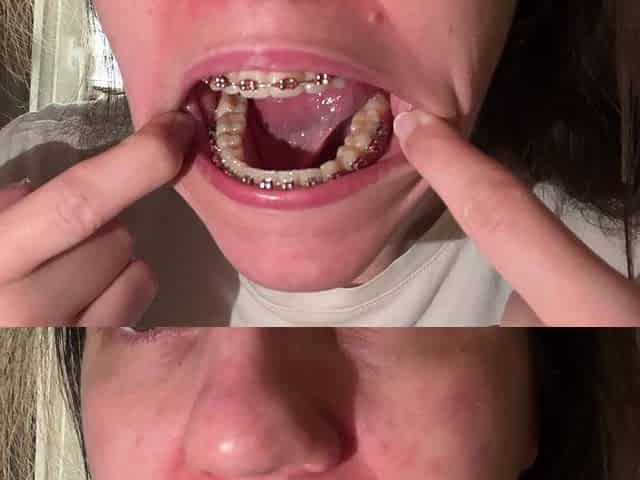 Licking Your Braces with Your Tongue