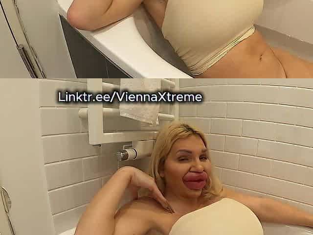 Bimbo Hotty talks to her BF in Bathtub after Plastic Surgery