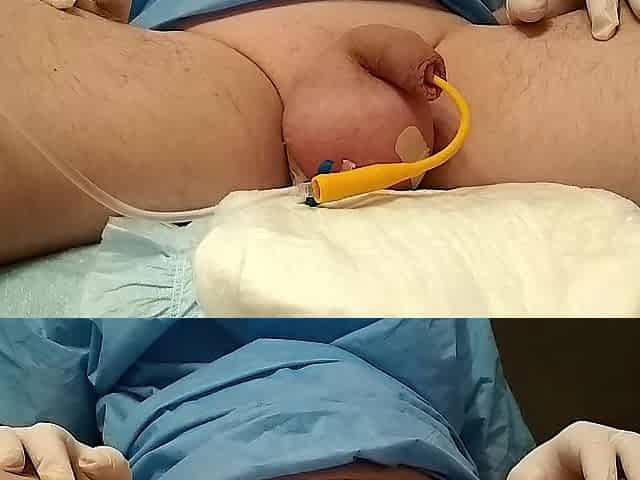 saline bladder enema with diaper