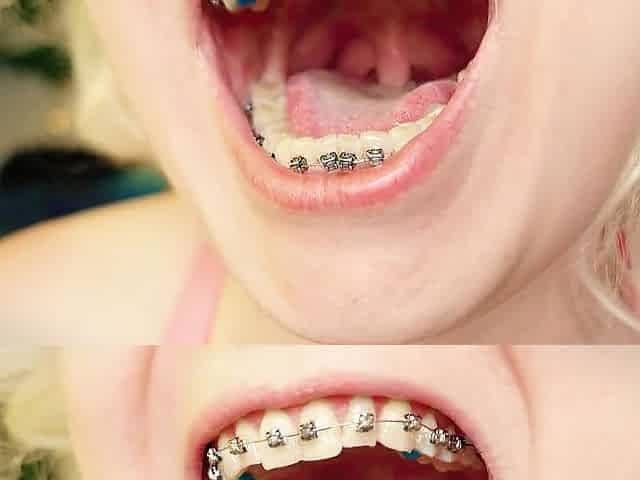 My 2nd day in braces: cleaning by dental floss