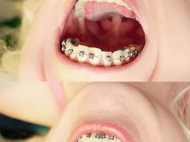 My 2nd day in braces: cleaning by dental floss