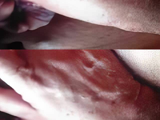sven42 Urethra sounding