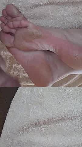 Best Cure for Callused Feet
