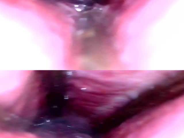 Deep Insight Into Wide Open Urethra - Part 1